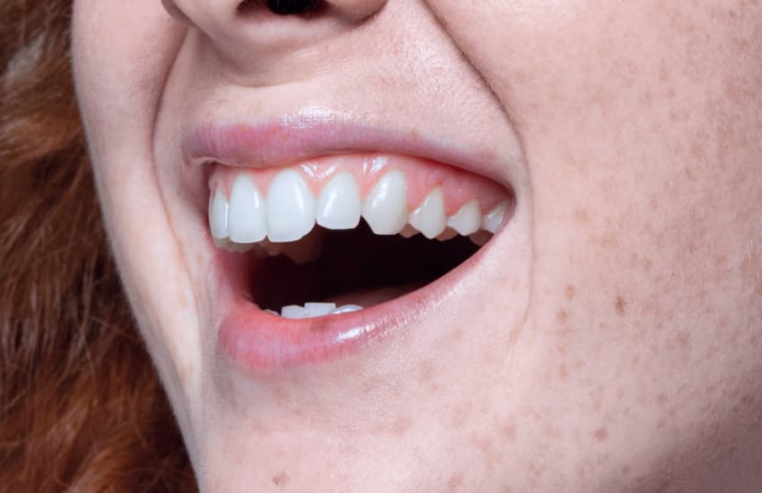 Dental Fillings in Boston, MA - Center Plaza Dental