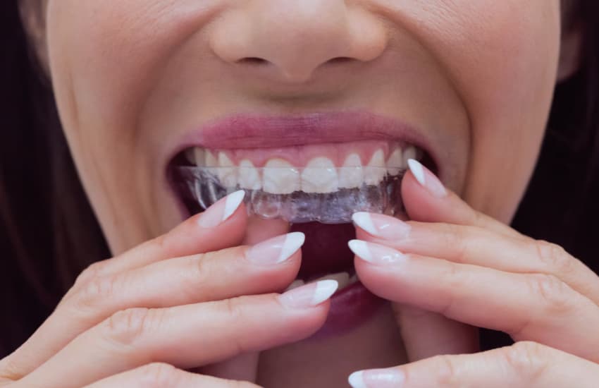 Invisalign in Boston, MA - Center Plaza Dental