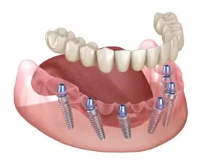 image of full arch dental implants